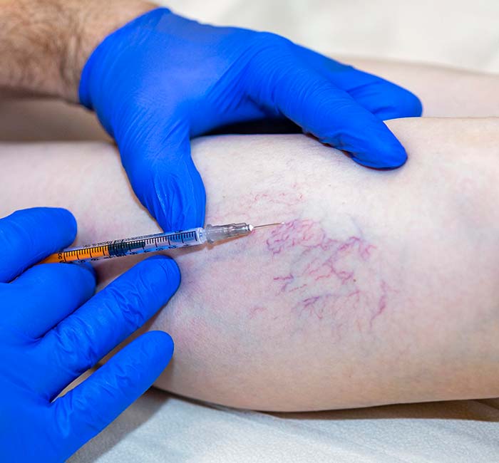 Escleroterapia 