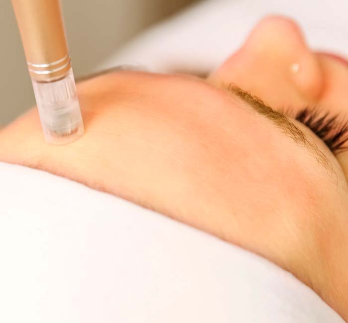 Microneedling